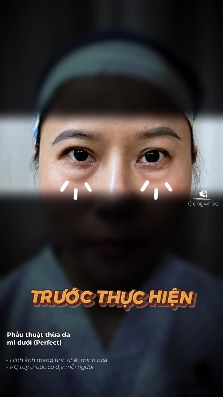 Phương pháp cắt mí dưới giúp cải thiện tình trạng lão hóa ở bờ mi dưới. Bác sĩ sẽ loại bỏ lượng da chùng và bọng mỡ mí dưới vừa đủ để đảm bảo kết quả tự nhiên và hài hòa