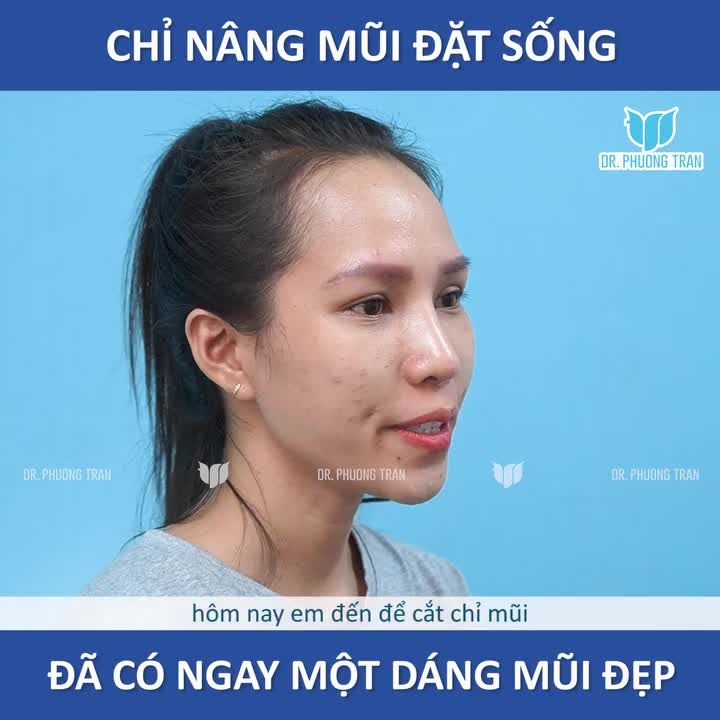 Phương án nâng mũi nào phù hợp với bạn?