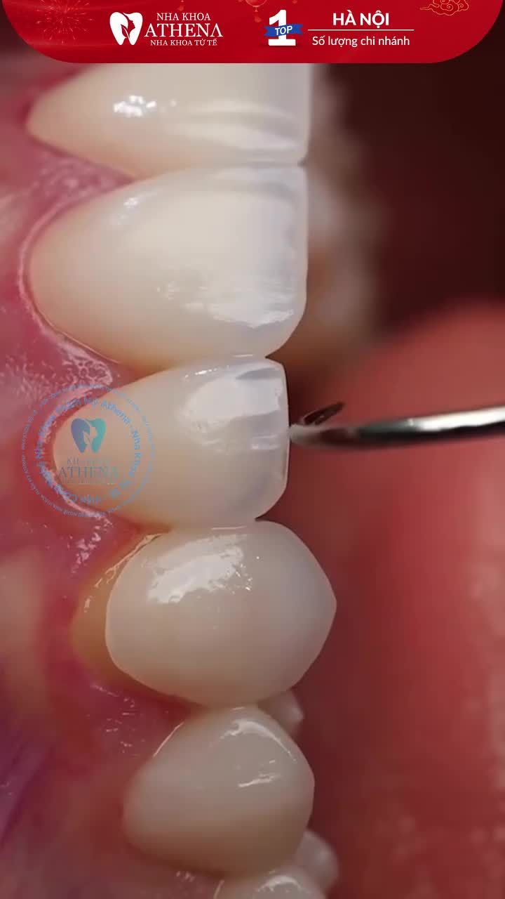 Sự tinh tế của một nụ cười đẹp không chỉ nằm ở dáng răng mà còn ở độ khít sát tuyệt đối giữa răng sứ và nướu.