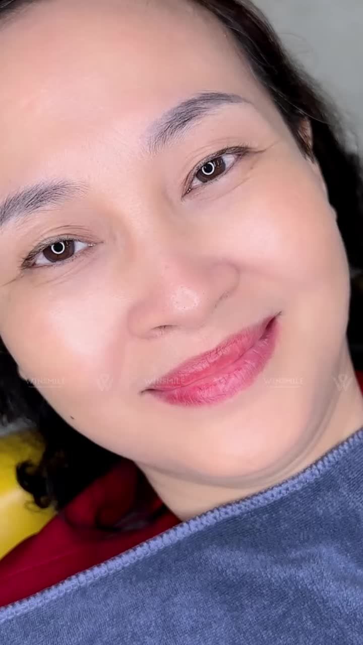 Win Smile Hồ Chí Minh được có cơ hội đồng hành cùng cô giáo Hoàng Chung đến từ Bình Dương trong hành trình biến hình nụ cười, mở ra một diện mạo mới thanh lịch, tươi tắn và tràn đầy sự tự tin.