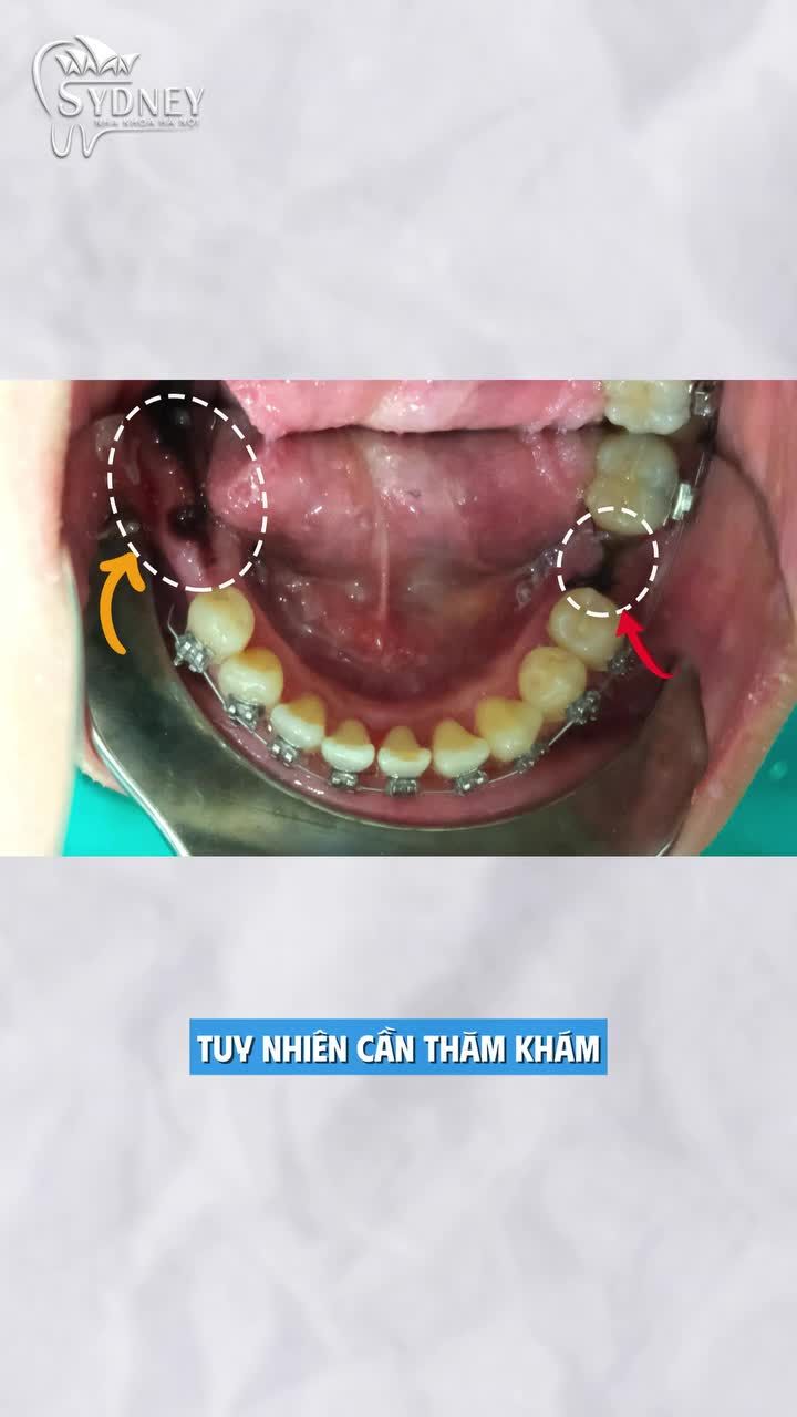 Mất răng có niềng răng được không?