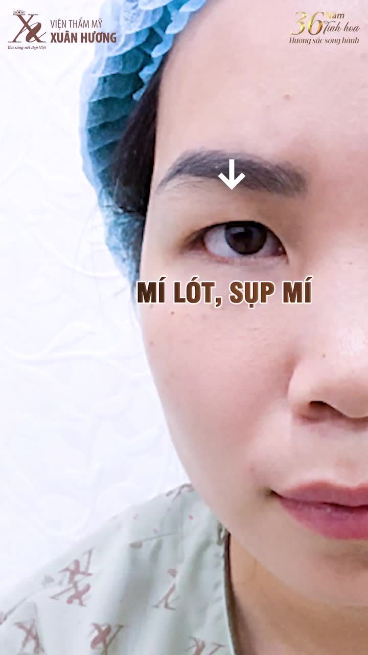 THĂNG HẠNG NHAN SẮC CHỈ SAU 45P CẮT MÍ TẠI VIỆN THẨM MỸ XUÂN HƯƠNG