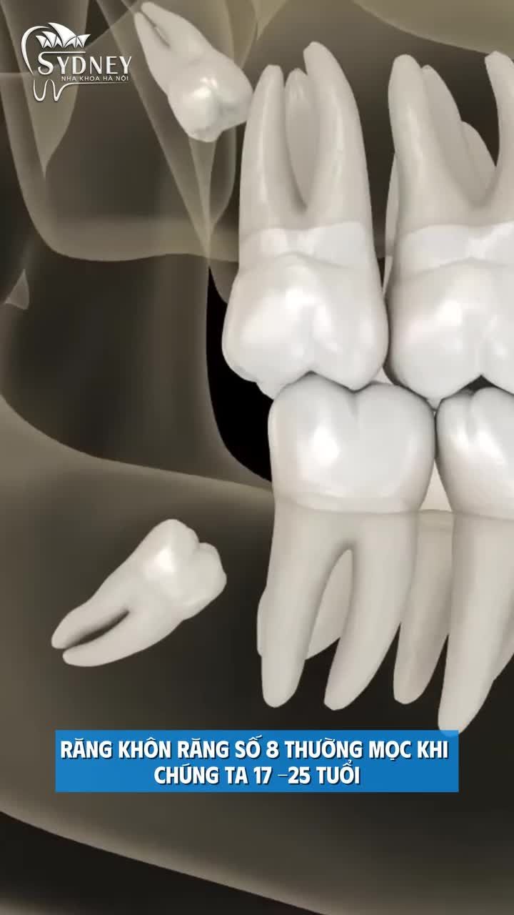Phân biệt các kiểu răng khôn mọc lệch