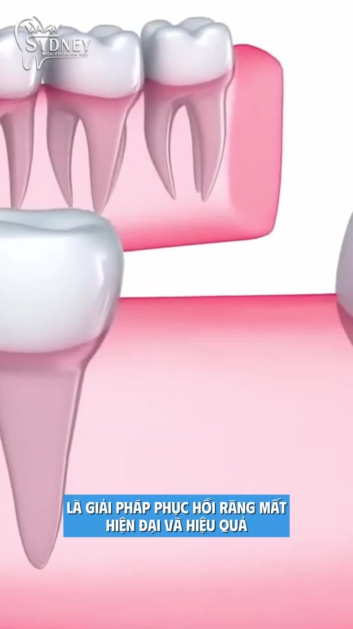 4 Trường hợp chống chỉ định cấy ghép Implant