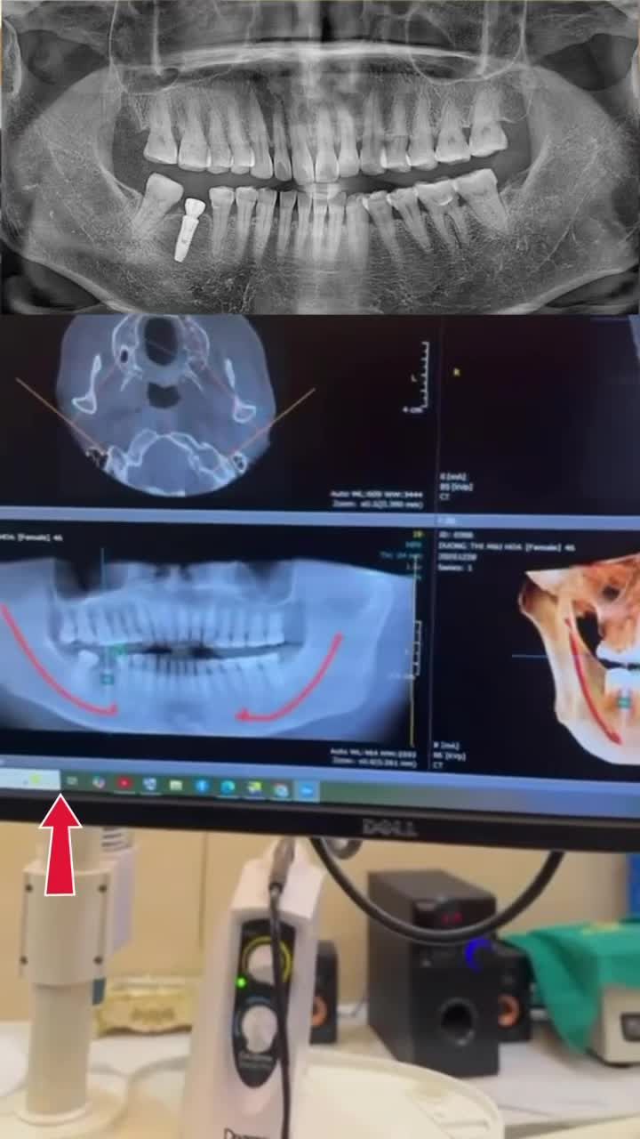 MẤT RĂNG TRỒNG IMPLANT- GIẢI PHÁP PHỤC HỒI CHO TRƯỜNG HỢP RĂNG MẤT