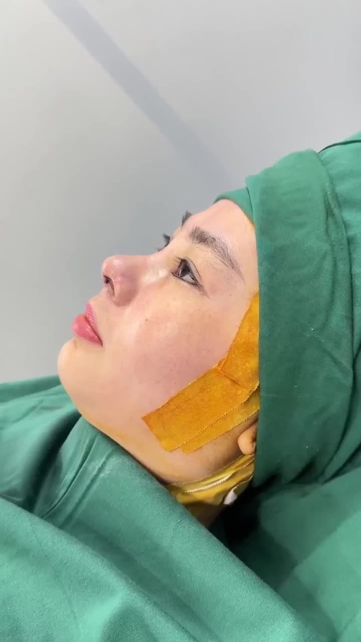 KẾT QUẢ SAU 60 PHÚT NÂNG MŨI CẤU TRÚC DR. HOẠT