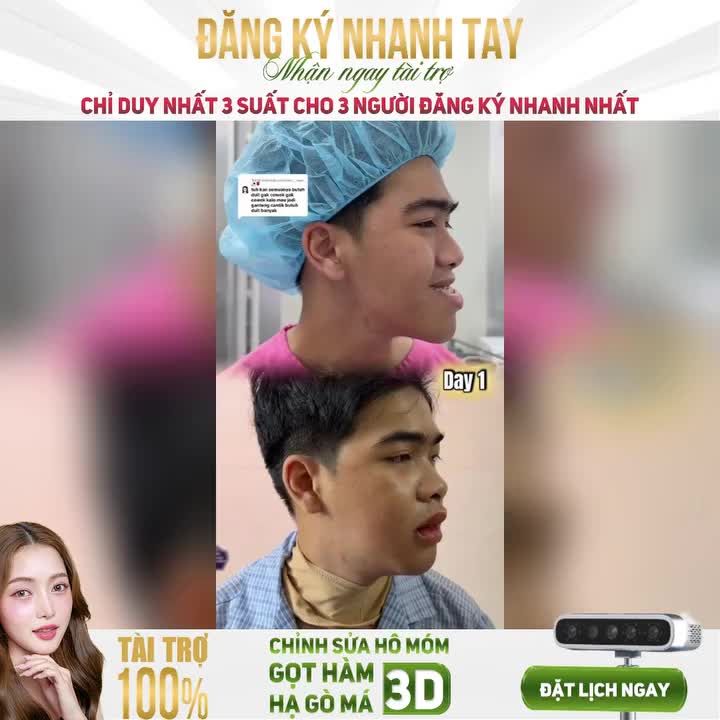 ĐĂNG KÝ NHANH TAY - NHẬN NGAY TÀI TRỢ GỌT HÀM, CHỈNH HÔ MÓM