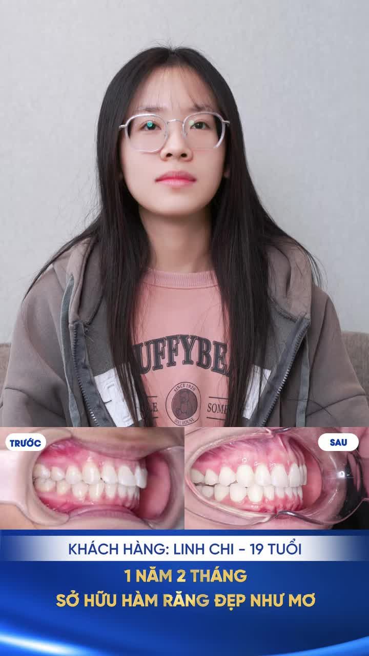 Từng không thể khép kín miệng vì răng hô Cô gái 2k6 "lột xác" ngoạn mục chỉ sau 1 năm 2 tháng.