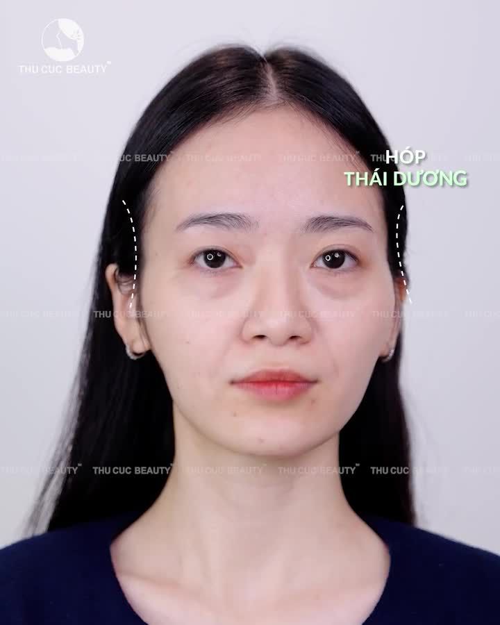 Tiêm filler fullface chỉ từ 3TR/cc chính là giải pháp