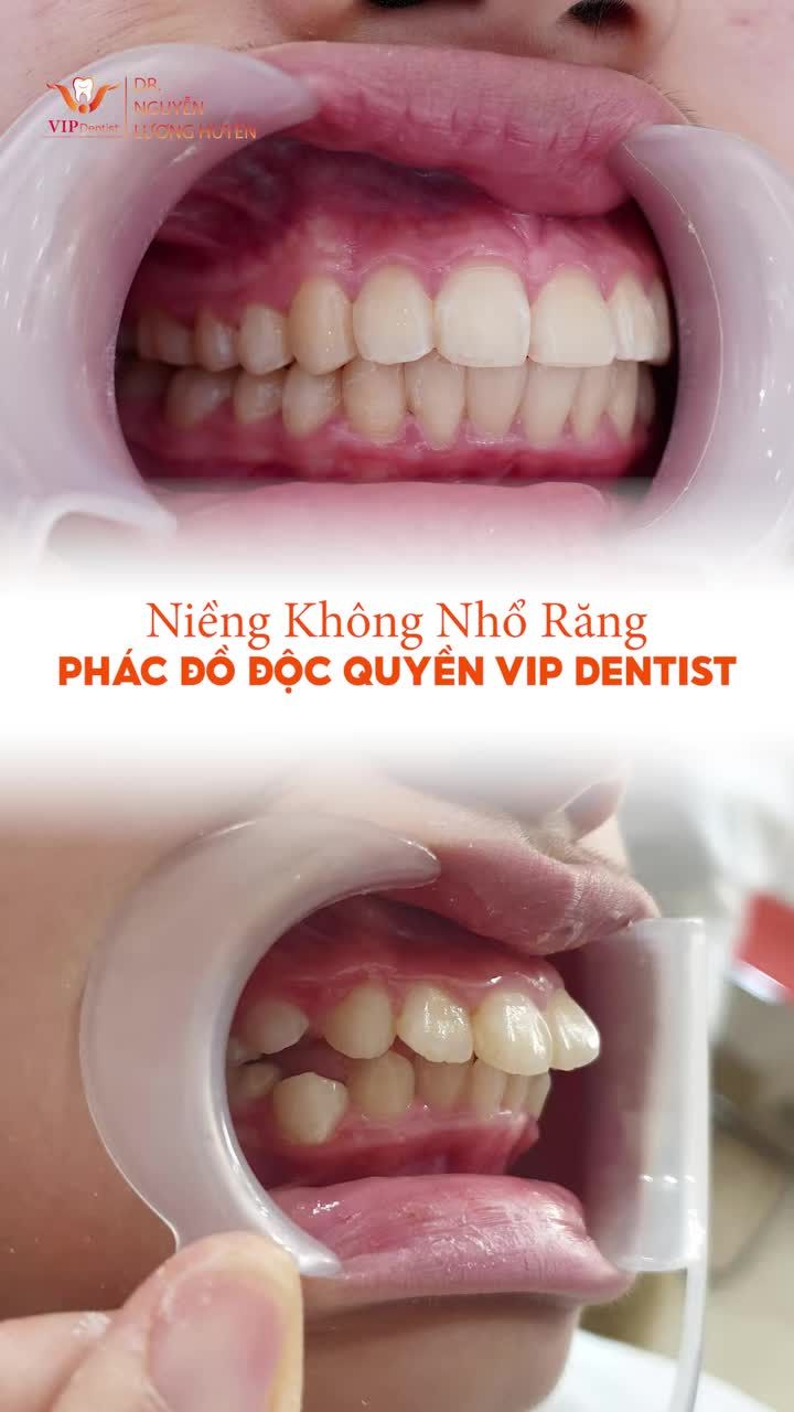 Niềng răng không nhổ răng - Hiệu quả trong mọi trường hợp Hô/Móm - Lệch khớp cắn