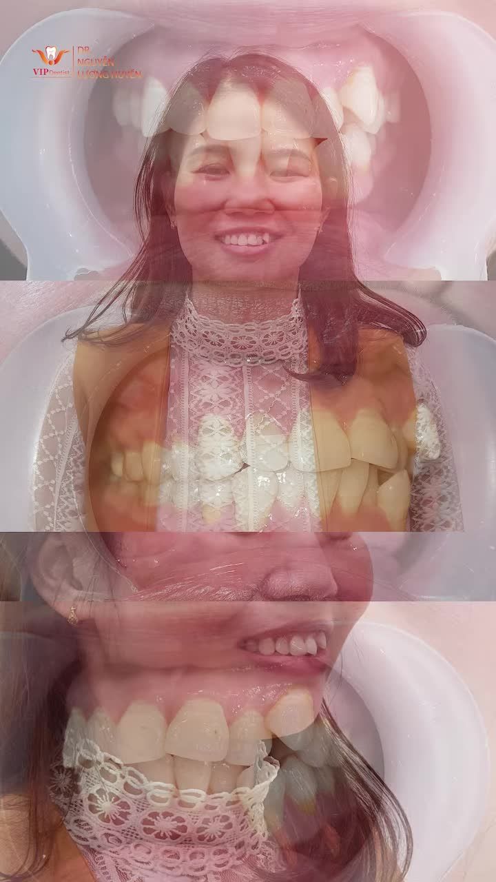 HƠN 2 NĂM KIÊN TRÌ ĐỔI LẤY DIỆN MẠO CÙNG NỤ CƯỜI AI CŨNG KHẢI “WOW”