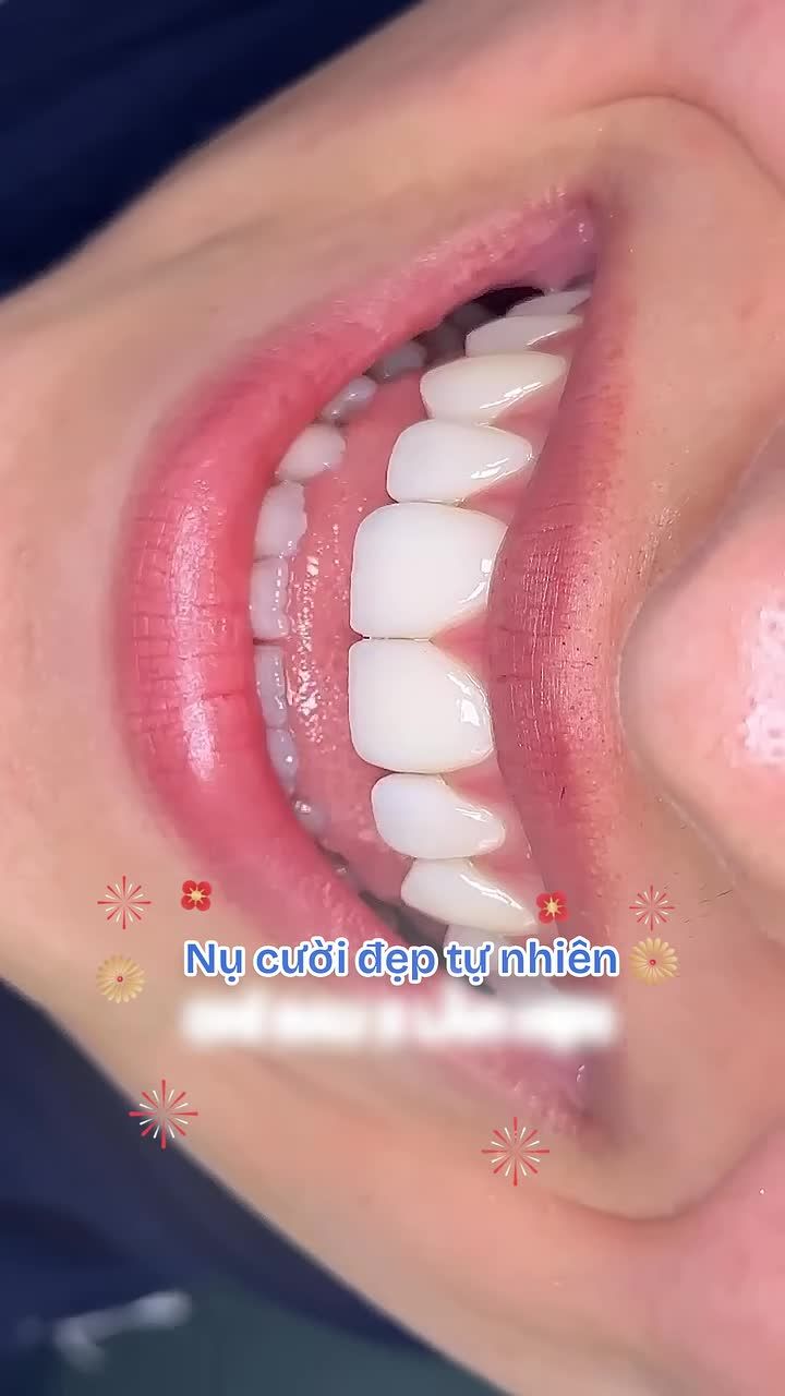 Say bye răng thưa/xỉn màu/ mòn men đón Tết Bính Ngọ chỉ sau 2 lần hẹn tại Nha khoa Paris