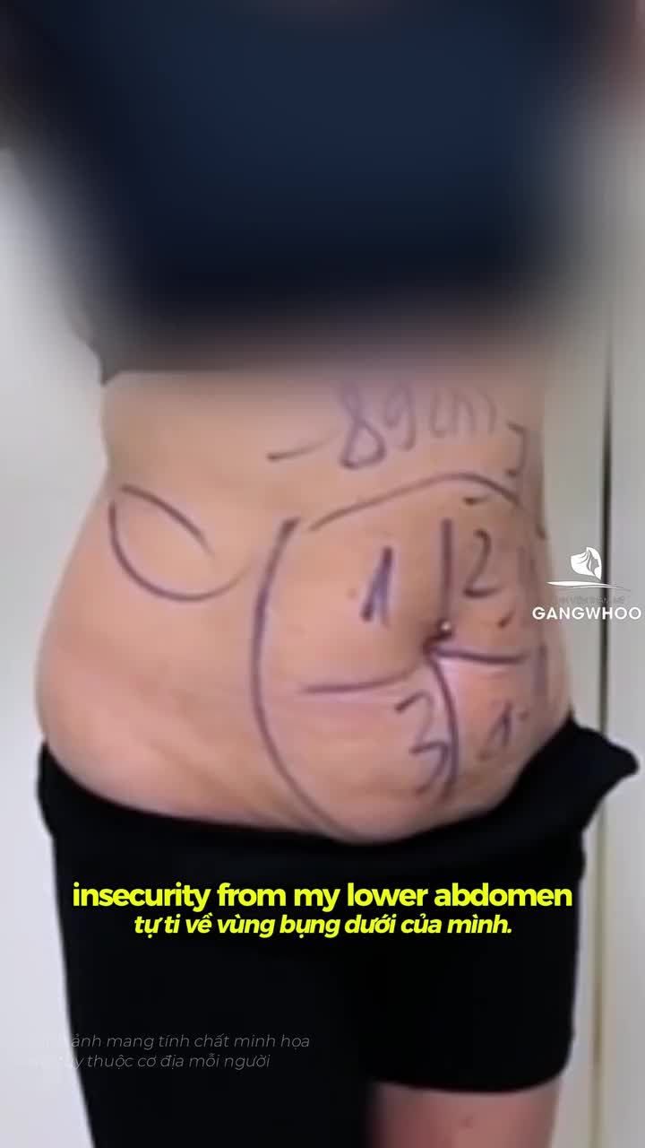 1 Ngày Hậu Op Sau Phẫu Thuật Căng Da Bụn