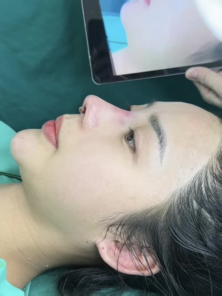 NÂNG MŨI CẤU TRÚC SỬA LẠI KẾT HỢP CẮT MÍ  CÁI KẾT ĐẸP TUYỆT SAU 10 NGÀY!!