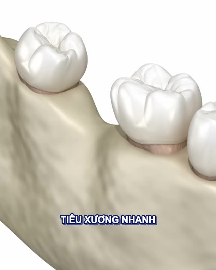 TIỂU ĐƯỜNG VẪN CÓ THỂ TRỒNG RĂNG IMPLANT AN TOÀN, ĂN NHAI TỐT