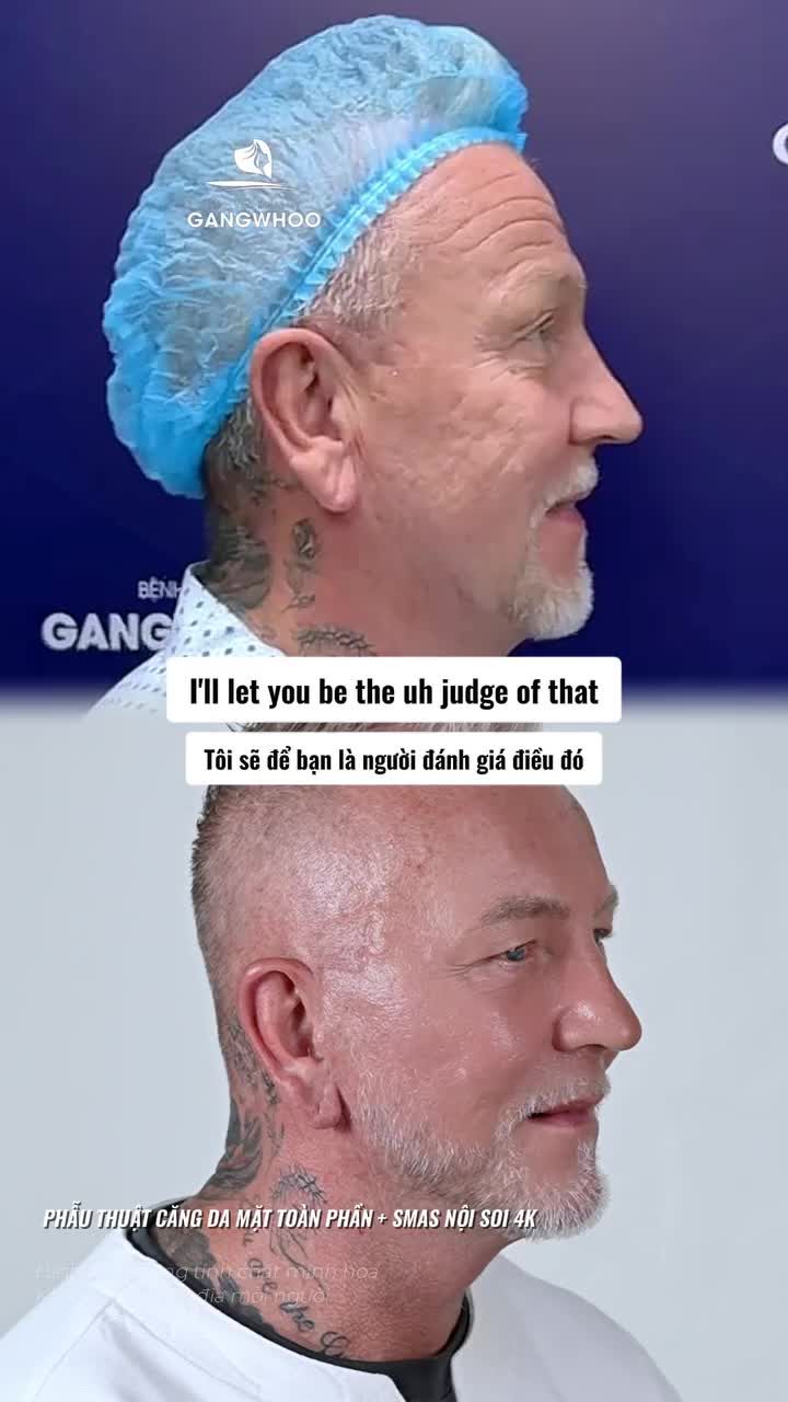 Quá nhiều thay đổi sau 3 tháng thực hiện phẫu thuật căng da mặt toàn phần + Smas nội soi 4K