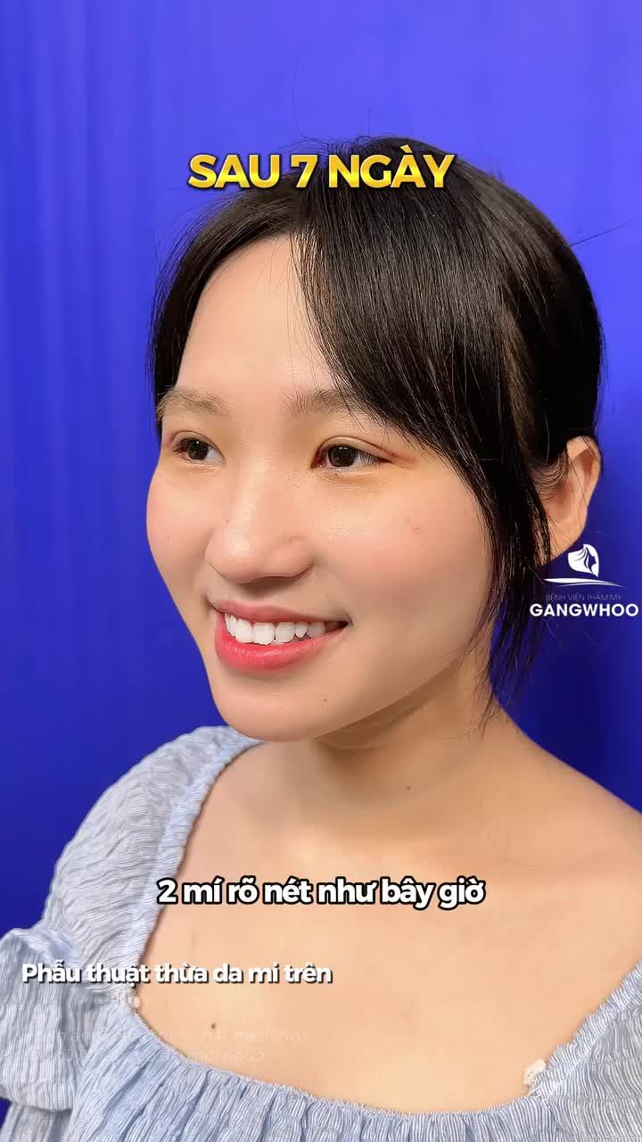 Ai bảo cắt mí là phải nghỉ dưỡng lâu? Xem ngay các bước trước khi có được kết quả sau 7 ngày của mình tại BVTM Gangwhoo nhé!