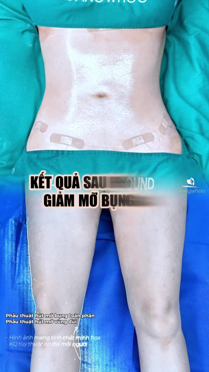 Việt kiều Úc review giảm mỡ bụng đùi tại Gangwhoo làm không đau, đi đứng nhẹ nhàng