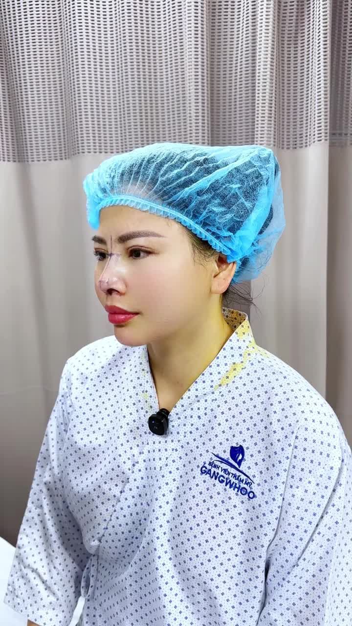 TẠI SAO NÂNG MŨI XONG LẠI THẤY MẶT V-LINE HƠN? CHIA SẺ TỪ CHỊ KHÁCH BÌNH DƯƠNG