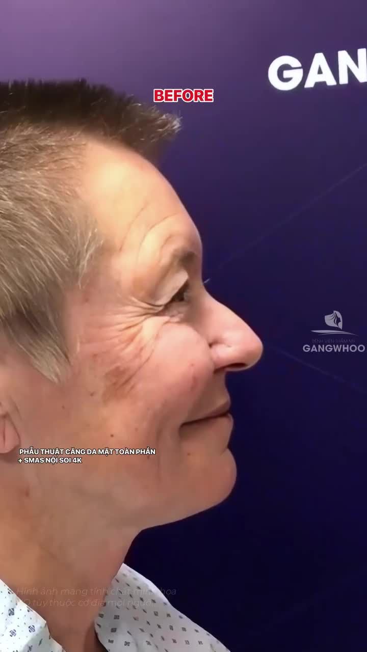 Nhan sắc này như trở về 15 năm trước sau phẫu thuật căng da mặt toàn phần + Smas nội soi 4K
