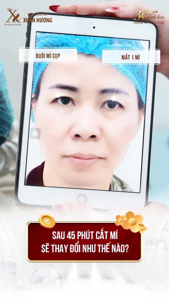 CHỈ 45 PHÚT CẮT MÍ TẠI VTM XUÂN HƯƠNG