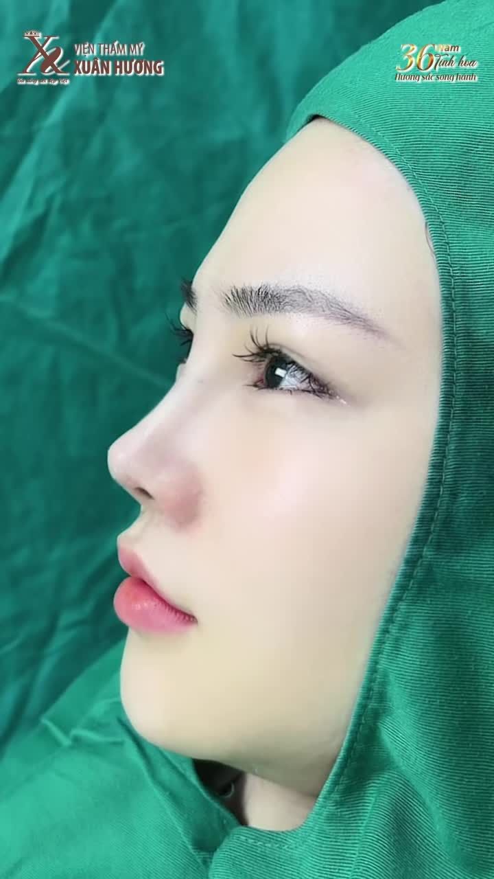 DÁNG MŨI SAU 10 NGÀY - CẬN CẢNH KHI KHÁCH QUAY LẠI CẮT CHỈ