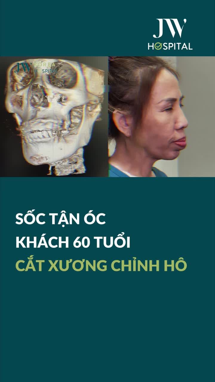 NỮ VIỆT KIỀU MỸ U60 BAY 15.000KM CẦU CỨU BÁC SĨ TÚ DUNG CẮT HÀM TRÊN, DỜI HÀM DƯỚI CHỈNH HÀM HÔ