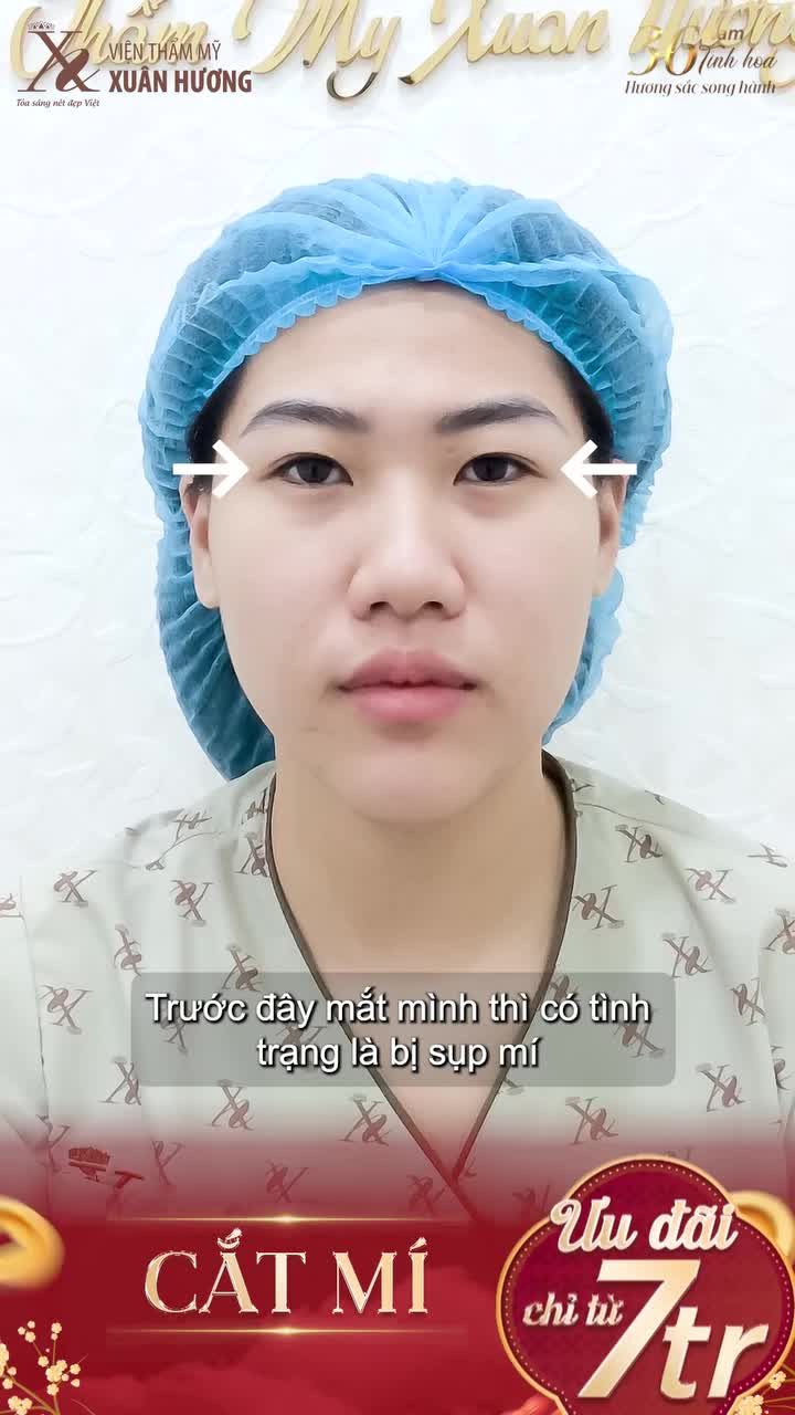 CẮT MÍ CHỈ TỪ 7 TRIỆU - TẾT NÀY KHỎI LO DÁN KÍCH MÍ