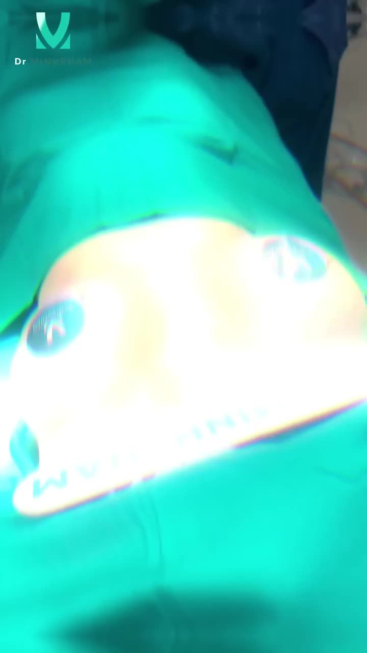 TREO SA TRỄ ĐẶT TÚI MENTOR XTRA 215CC