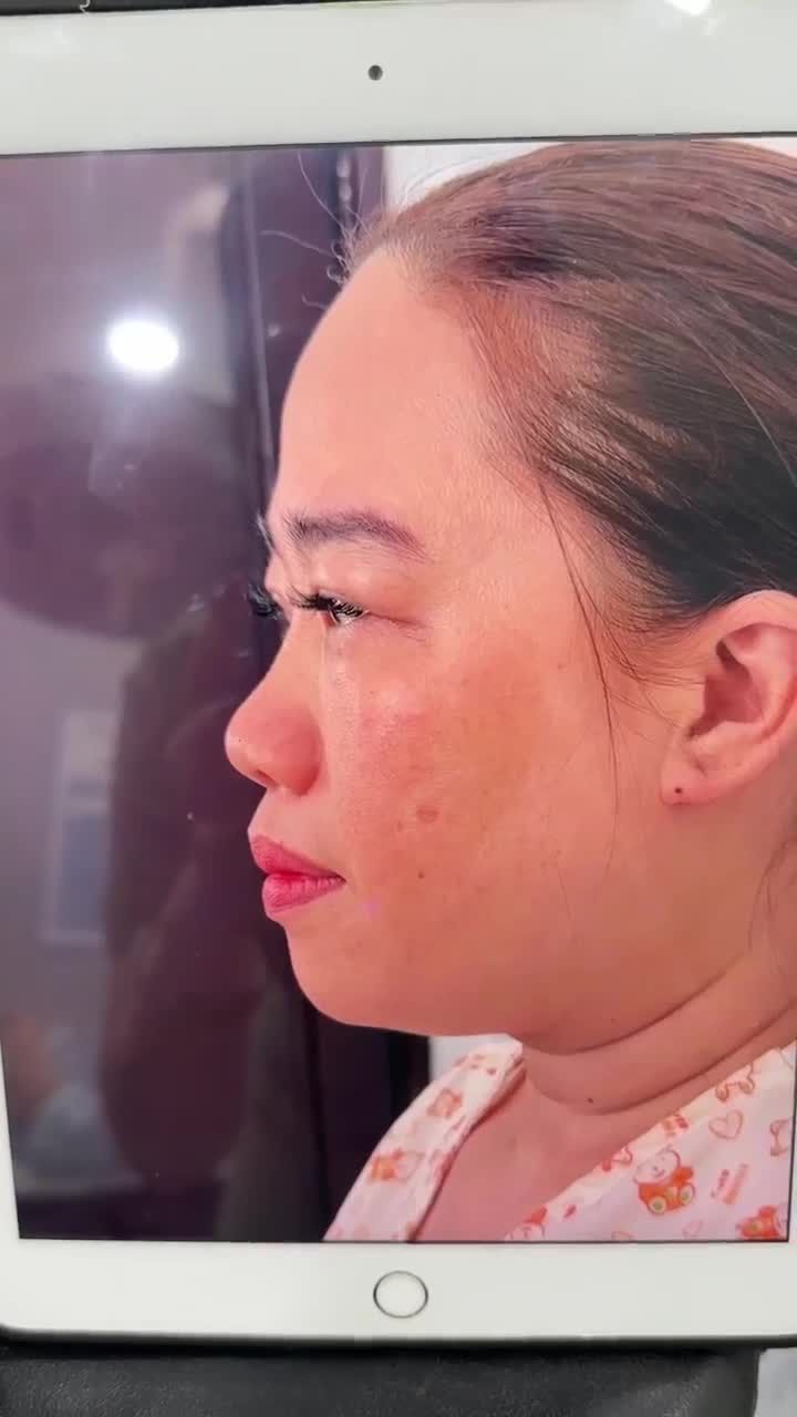 SAU 60 PHÚT NÂNG MŨI CẤU TRÚC + CẮT CÁNH MŨI