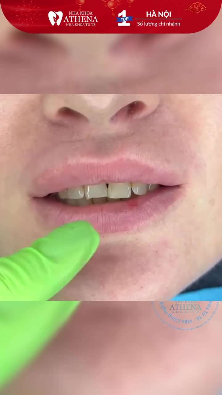 BẠN GIẤU ĐI NỤ CƯỜI CHỈ VÌ VẾT XỈN MÀU KÉM DUYÊN?