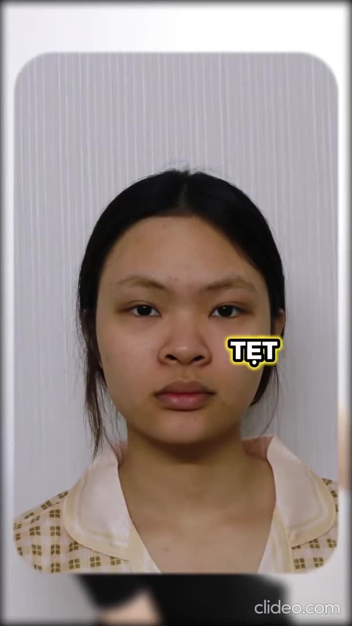 SỢ MŨI HỎNG - KHAO KHÁT DÁNG MŨI “TỰ NHIÊN NHƯ THẬT”?