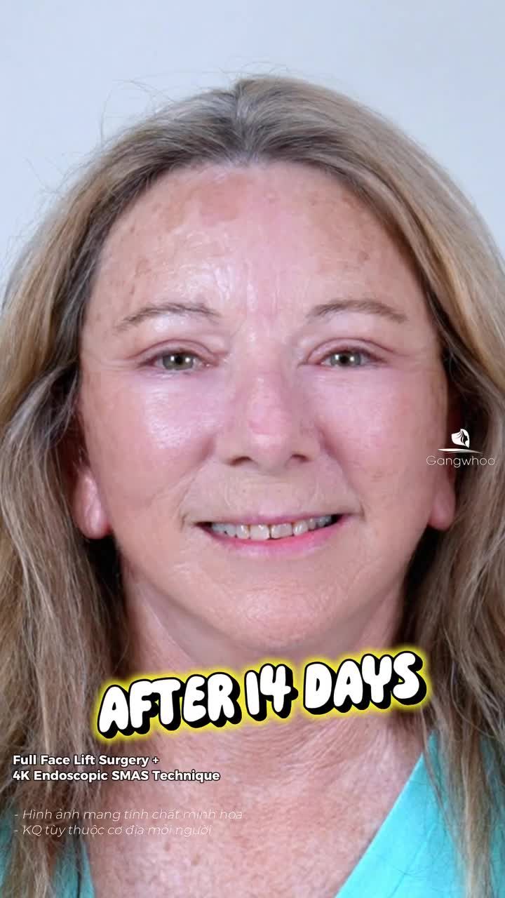 Khách hàng Quốc Tế Úc - 66 tuổi sau khi phẫu thuật căng da mặt toàn phần + Smas nội soi 4K đã thật sự trẻ lại 20 tuổi