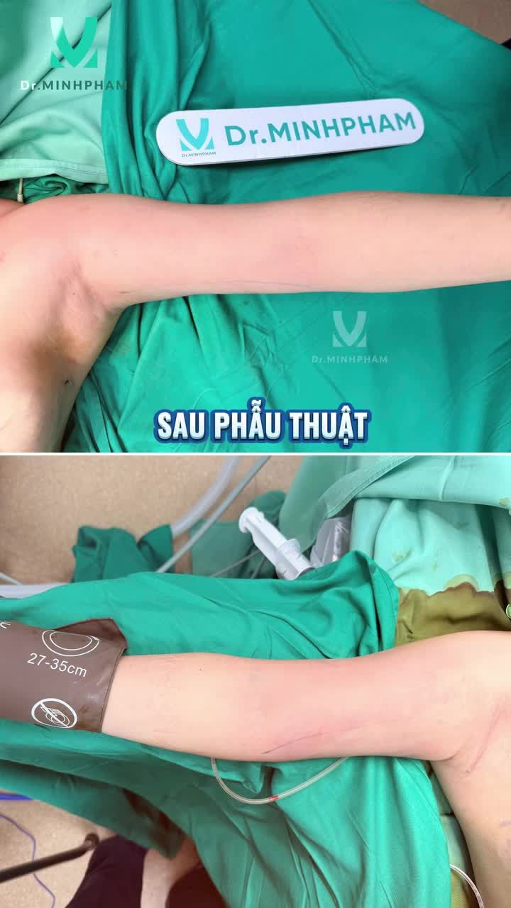 Bắp tay to từng là nỗi tự ti…