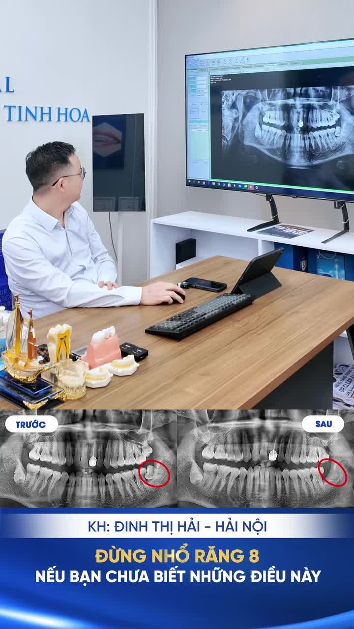 ĐỪNG VỘI NHỔ RĂNG KHÔN