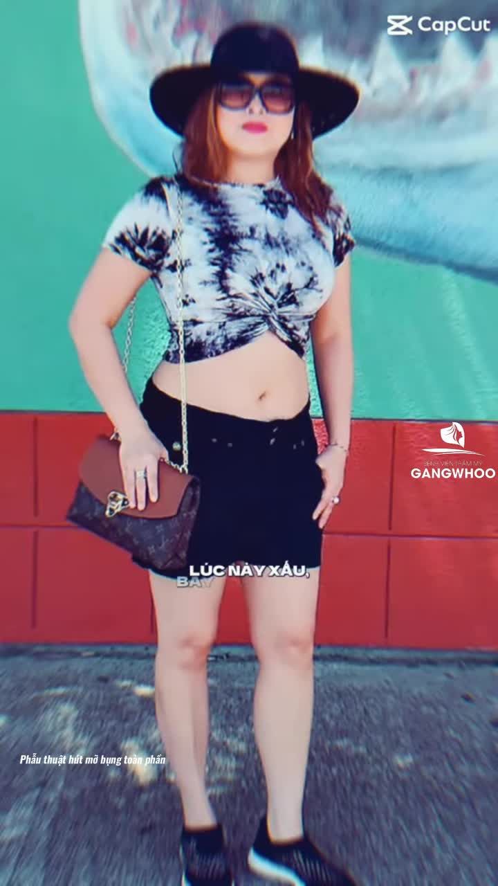 Chị khách Việt kiều Mỹ gửi feedback sau 2 năm giảm mỡ bụng tại Gangwhoo