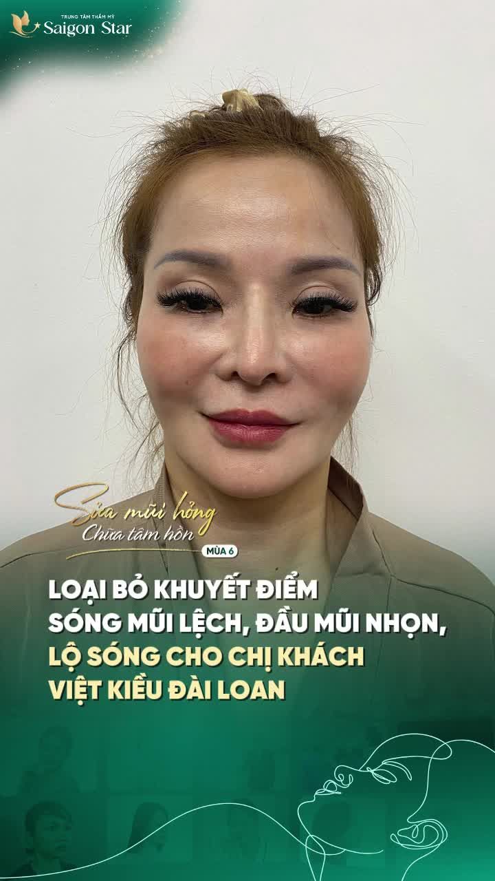 THÀNH CÔNG LOẠI BỎ KHUYẾT ĐIỂM MŨI CHO KHÁCH HÀNG VIỆT KIỀU ĐÀI LOAN