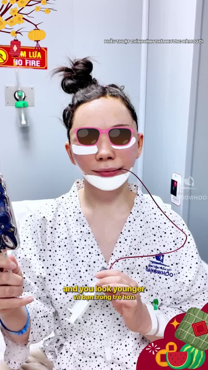 Trượt cằm + căng da mặt - gương mặt nâng tầm chỉ sau 1 tuần