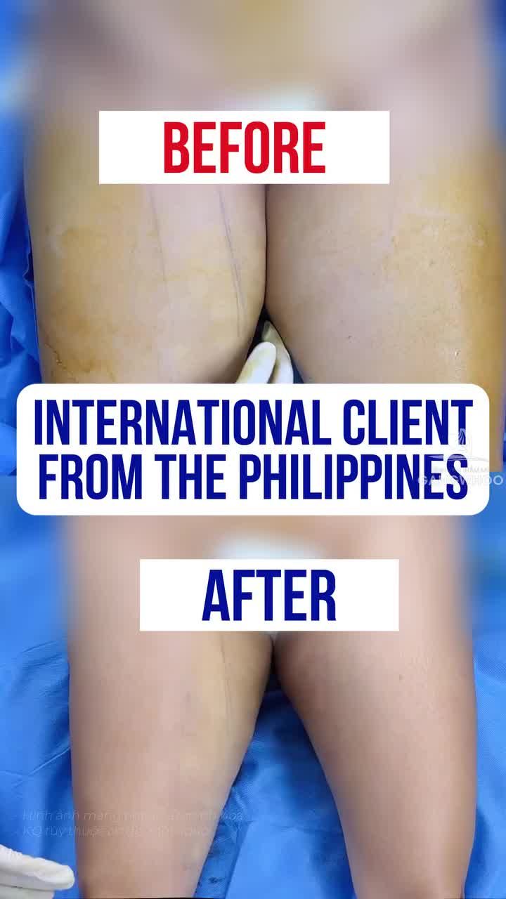 Kết quả giảm mỡ đùi sau 30 phút cho khách hàng đến từ Philippines.