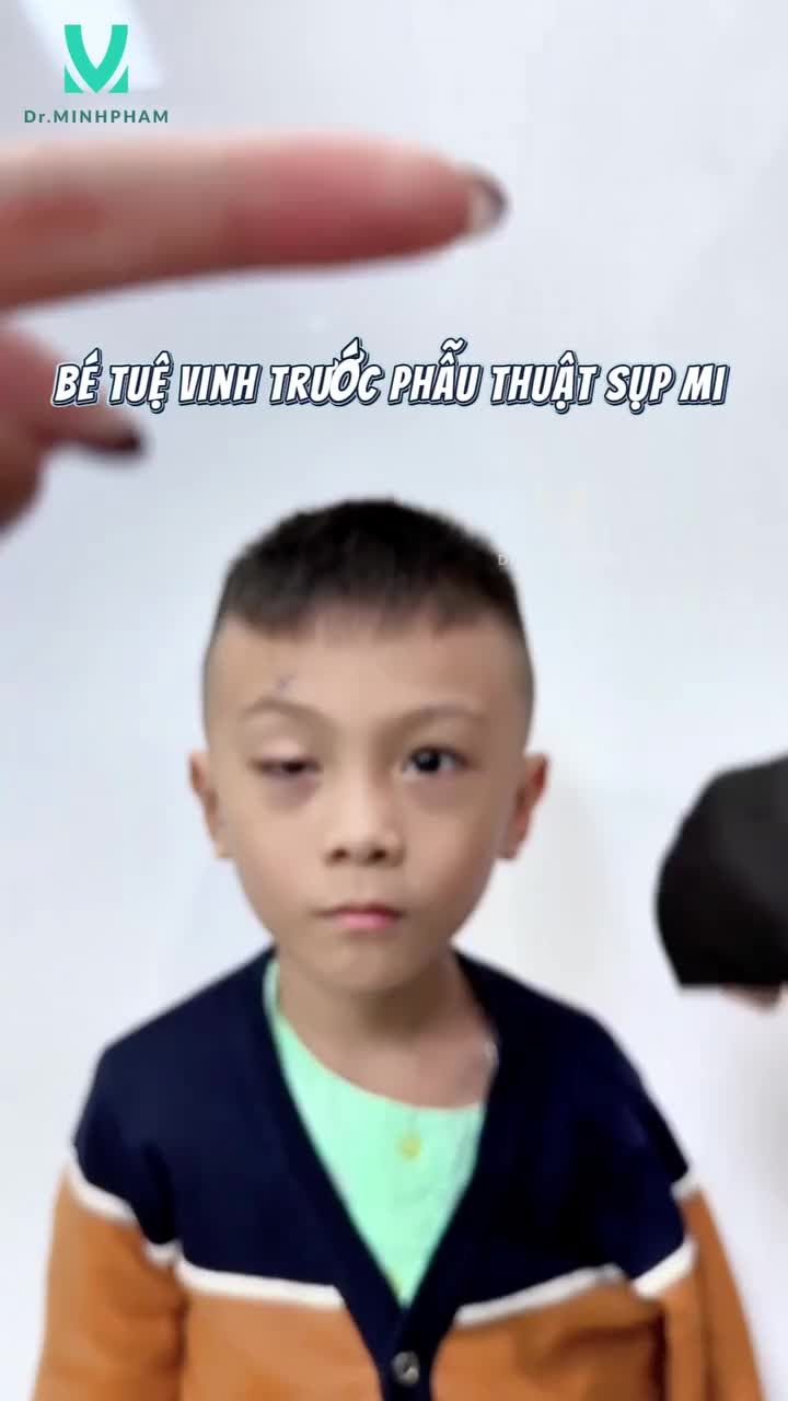 PHẪU THUẬT SỤP MI BẨM SINH SAU 2 THÁNG