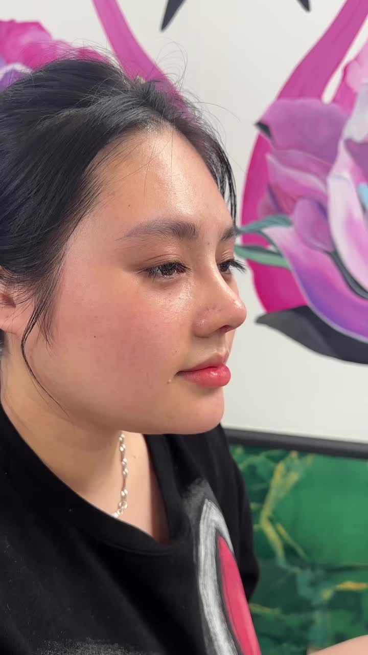 Mũi cấu trúc sửa lại sau 10 ngày