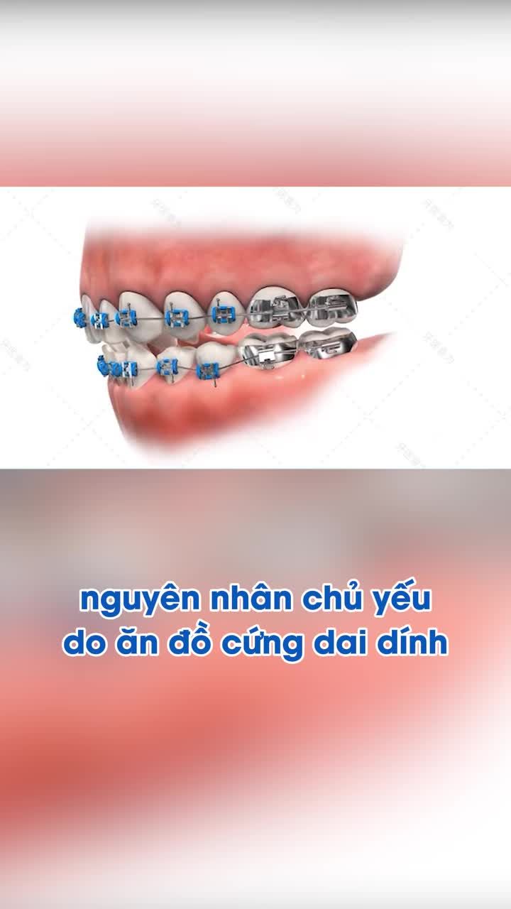 Niềng răng là luôn trọn gói nhé các bác