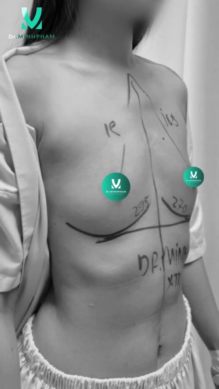 Nâng ngực Mentor Xtra 295CC – 270CC