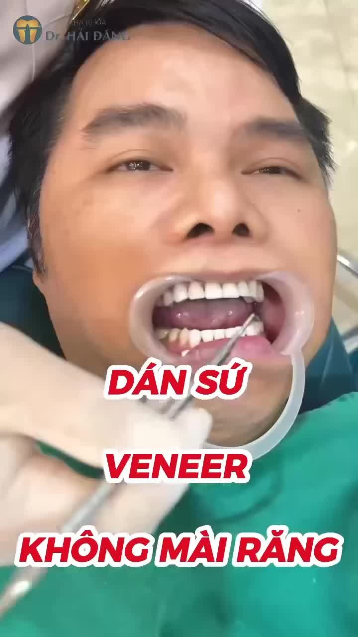 DÁN SỨ VENEER – KHÔNG MÀI RĂNG