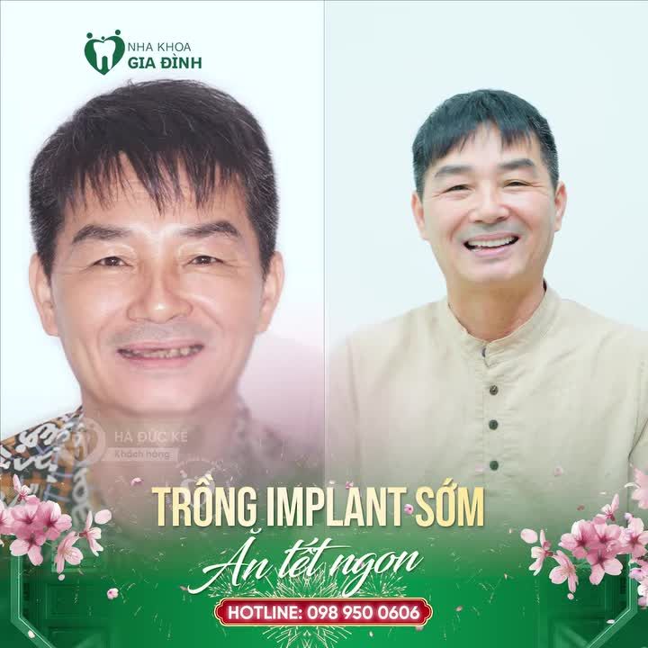 TRỒNG RĂNG IMPLANT GIẢI PHÁP HOÀN HẢO CHO CÔ CHÚ MẤT RĂNG