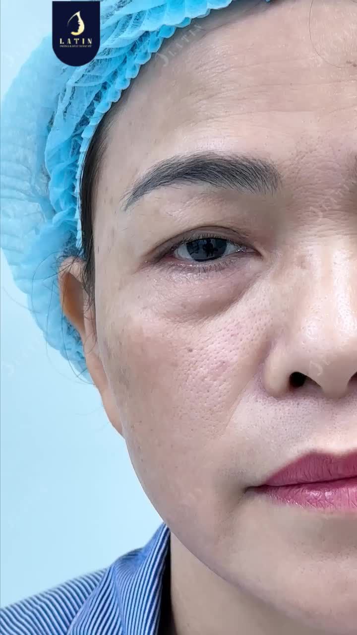 CHỈ 2 TIẾNG ĐỒNG HỒ XỬ LÝ TẤT TẦN TẬT CÁC VẤN ĐỀ LÃO HÓA VÙNG MẮT