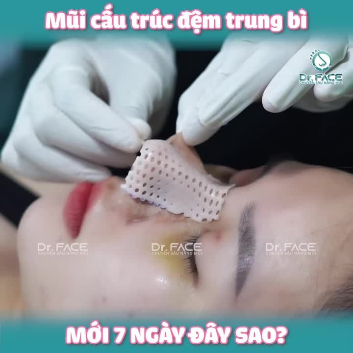 MŨI CẤU TRÚC ĐỆM TRUNG BÌ – MỚI 7 NGÀY MÀ ĐÃ THẤY RÕ SỰ KHÁC BIỆT