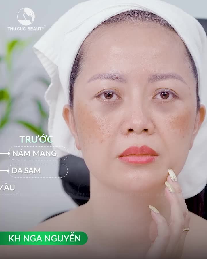 TOP những ca trị nám thành công tại Thu Cúc – xem xong chỉ muốn đi làm ngay! Không còn lớp che khuyết điểm dày cộm.