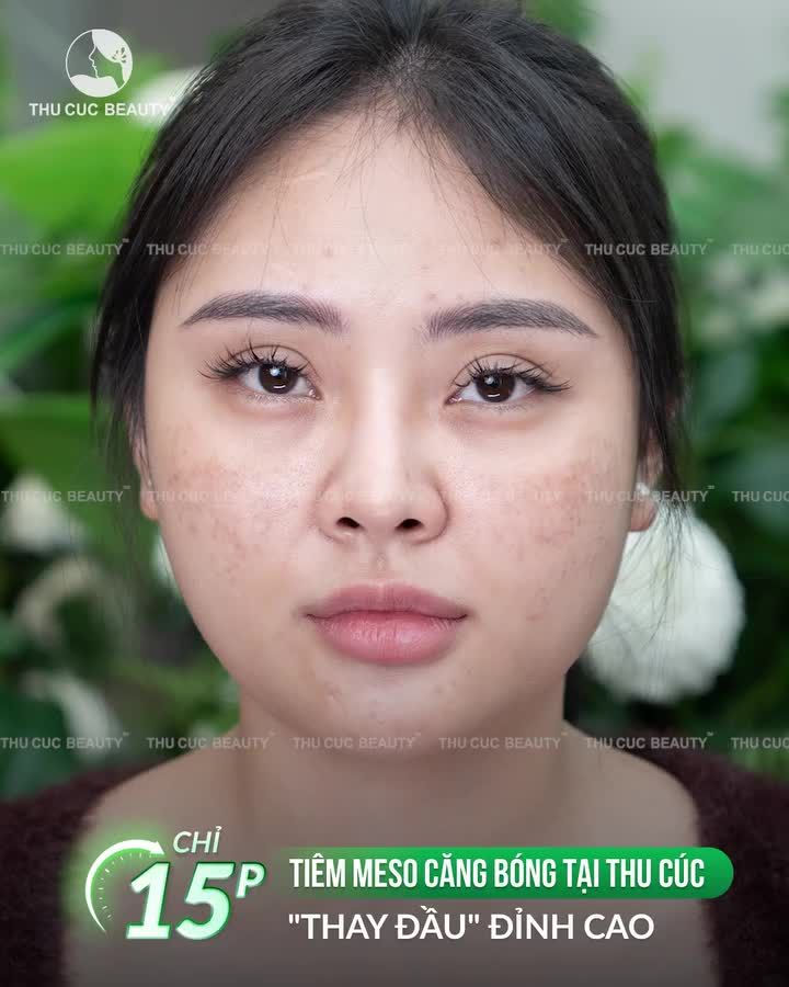 Meso căng bóng đang gần kín lịch – hiện chỉ còn 10 suất cuối Ai cũng tranh thủ làm đẹp, đừng để mình phải chờ đợi.