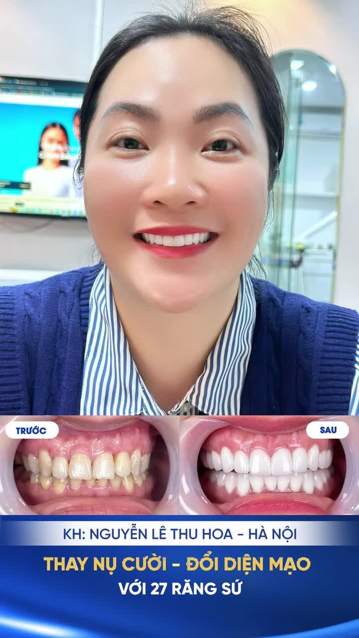 Hai năm trước,chị Thu Hoa (42 tuổi) từng niềng răng  tại Shinbi.